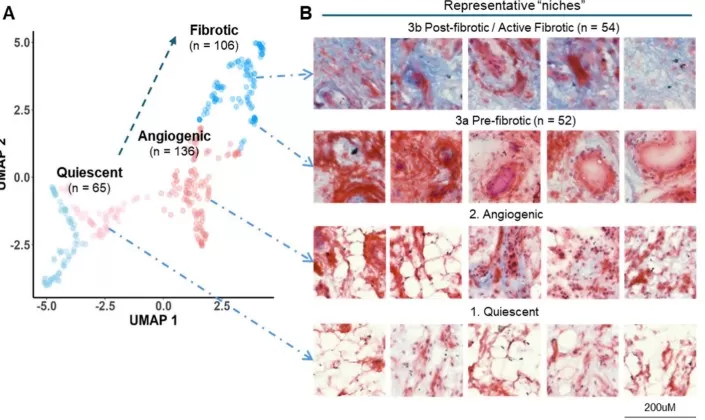 Spatially resolved proteomic and metabolomic imaging reveals synovitis endotypes